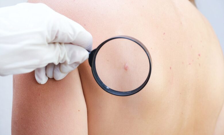 Día Mundial Contra el Cáncer: El Perú podría tener una edición especial de moneda de UN SOL para prevenir cáncer de piel