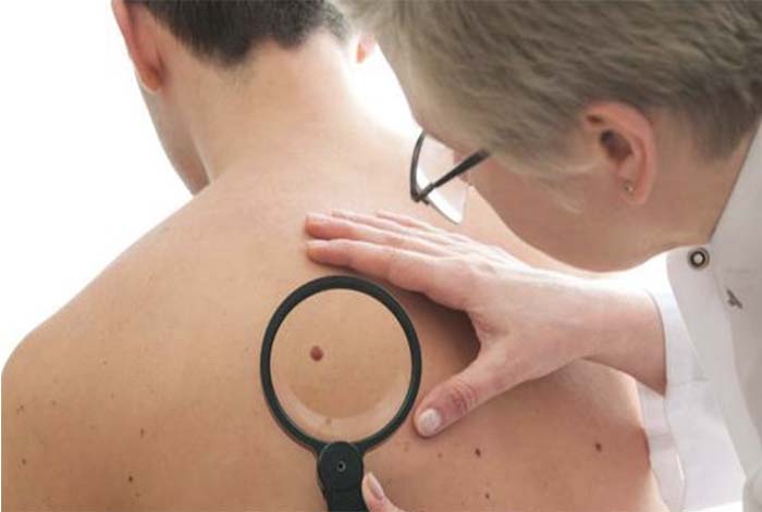 Cáncer de Piel: La regla del ABCDE de los lunares que ayuda a una detección oportuna de este tipo de cáncer