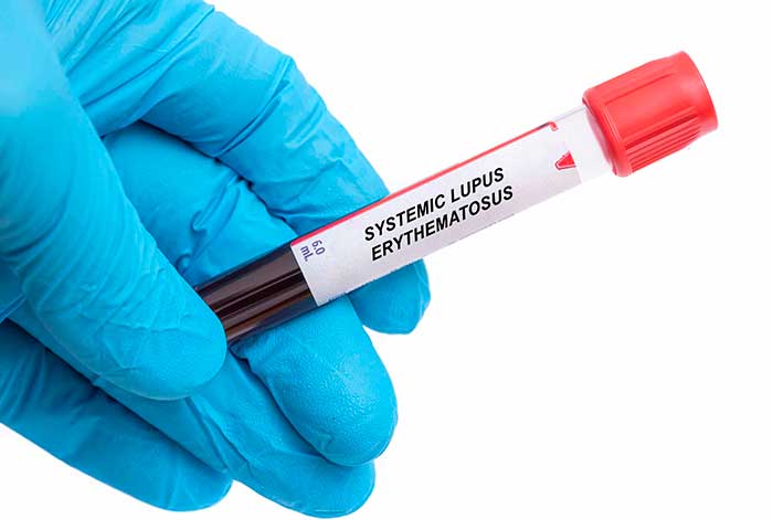 10 Cosas que debes saber sobre el Lupus