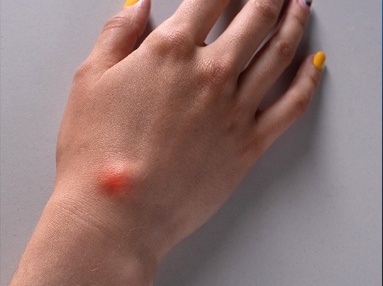 Sarcoma: 4 preguntas clave sobre esta enfermedad