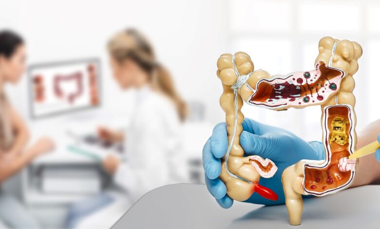 CONOZCA LAS SEÑALES QUE PUEDEN INDICAR CÁNCER COLORRECTAL