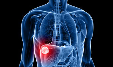 Cáncer de hígado: Perú registra más de 2,174 casos anuales de carcinoma hepatocelular
