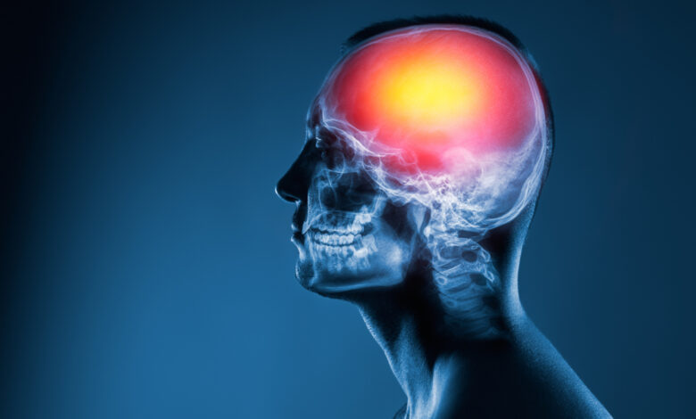 ¿Por qué aumentan los accidentes cerebrovasculares entre los jóvenes?