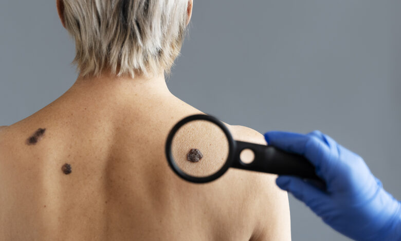 ¿Cómo prevenir el cáncer de piel con la identificación temprana de melanoma?