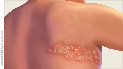 Herpes Zóster: Una enfermedad silenciosa y dolorosa que puede ser prevenida