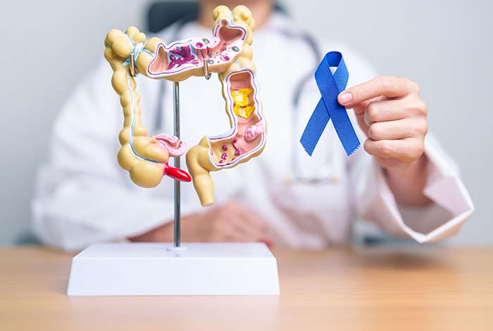 Día de la prevención de Cáncer de Colon: Cuatro consejos para reducir este riesgo