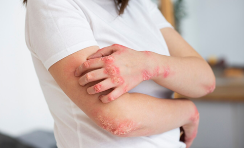 Sun Pharma presenta nuevo tratamiento de la psoriasis en Perú con ILUMYA