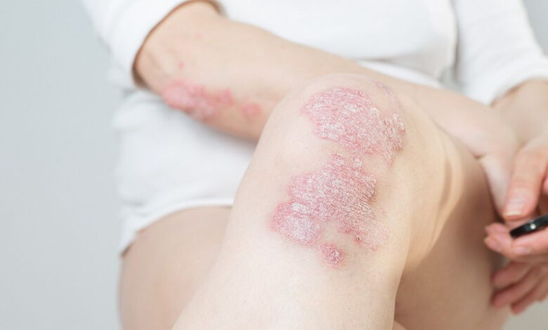 Sun Pharma revoluciona el tratamiento de la psoriasis en Perú con ILUMYA