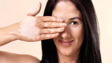 Día Mundial del Vitiligo: ¿Y si no es vitiligo? Tres diferencias clave con la psoriasis que deberías conocer