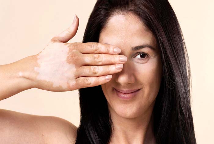 Día Mundial del Vitiligo: ¿Y si no es vitiligo? Tres diferencias clave con la psoriasis que deberías conocer