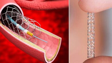 los síntomas en pacientes seleccionados. “Gracias a estas innovaciones, hoy podemos ofrecer mayores probabilidades de recuperación funcional e independencia a quienes sufren un ataque cerebral”, resaltó el especialista. En el marco del Día Mundial del Ataque Cerebrovascular, médicos de distintas especialidades y hospitales en todo el país se suman al esfuerzo global por educar, sensibilizar y promover la detección temprana, así como difundir los avances que están transformando el tratamiento del ataque cerebral. Porque en un ataque cerebrovascular, cada minuto cuenta.