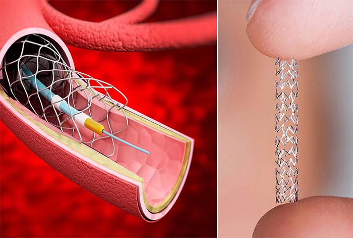 los síntomas en pacientes seleccionados. “Gracias a estas innovaciones, hoy podemos ofrecer mayores probabilidades de recuperación funcional e independencia a quienes sufren un ataque cerebral”, resaltó el especialista. En el marco del Día Mundial del Ataque Cerebrovascular, médicos de distintas especialidades y hospitales en todo el país se suman al esfuerzo global por educar, sensibilizar y promover la detección temprana, así como difundir los avances que están transformando el tratamiento del ataque cerebral. Porque en un ataque cerebrovascular, cada minuto cuenta.