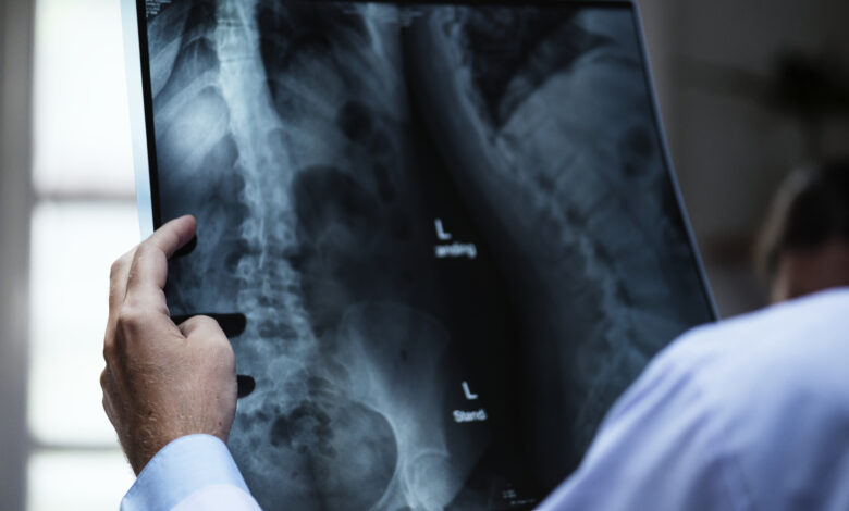 ¿Recibes más radiación en un avión o en una radiografía?