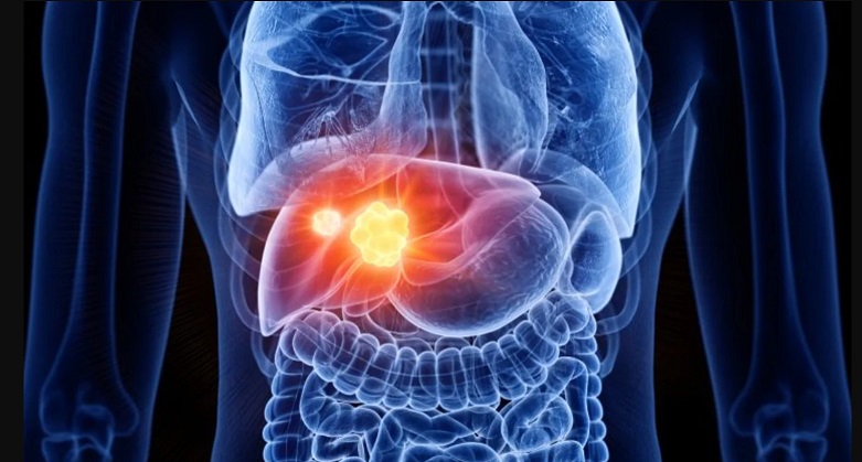 La hepatitis B: el virus silencioso que puede causar cáncer de hígado