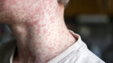 Sarampión en Perú: ¿qué tan protegidos estamos ante el avance de los contagios?